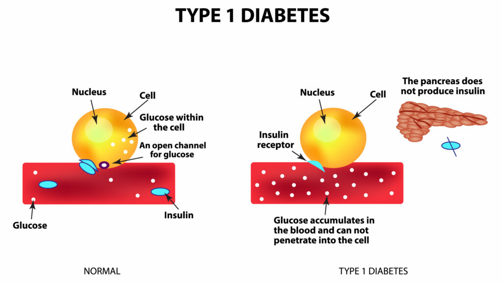What causes Type 1 Diabetes? – Glucose Guards