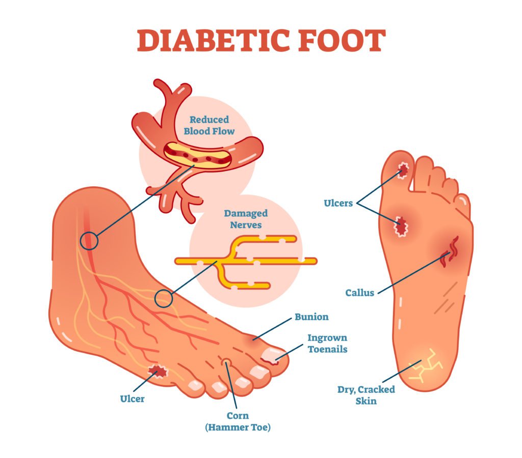 diabetic foot illustration showing uclers, callus and other